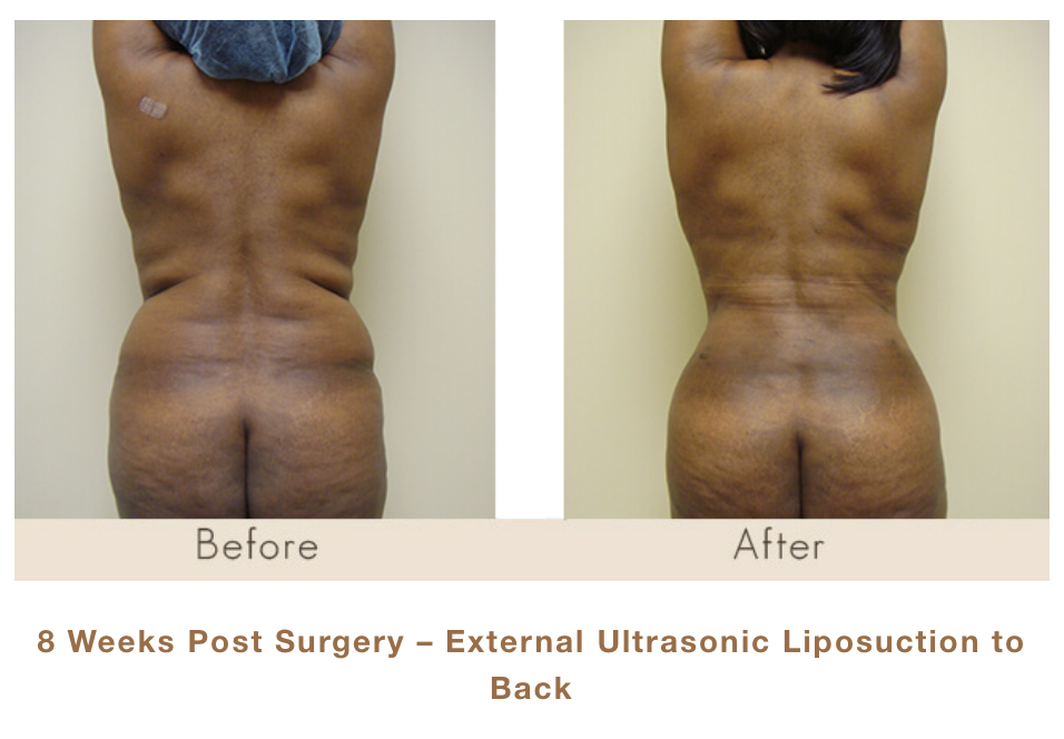 8 weeks post surgery - external ultrasonic liposuction to back